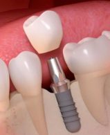 implant-zub