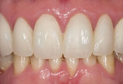 белые зубы после процедуры