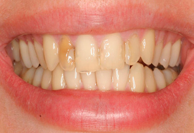 белые зубы до процедуры