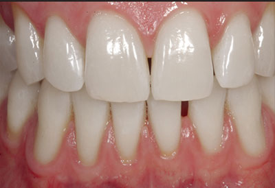 белые зубы